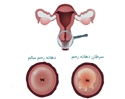 عکس سرطان دهانه رحم