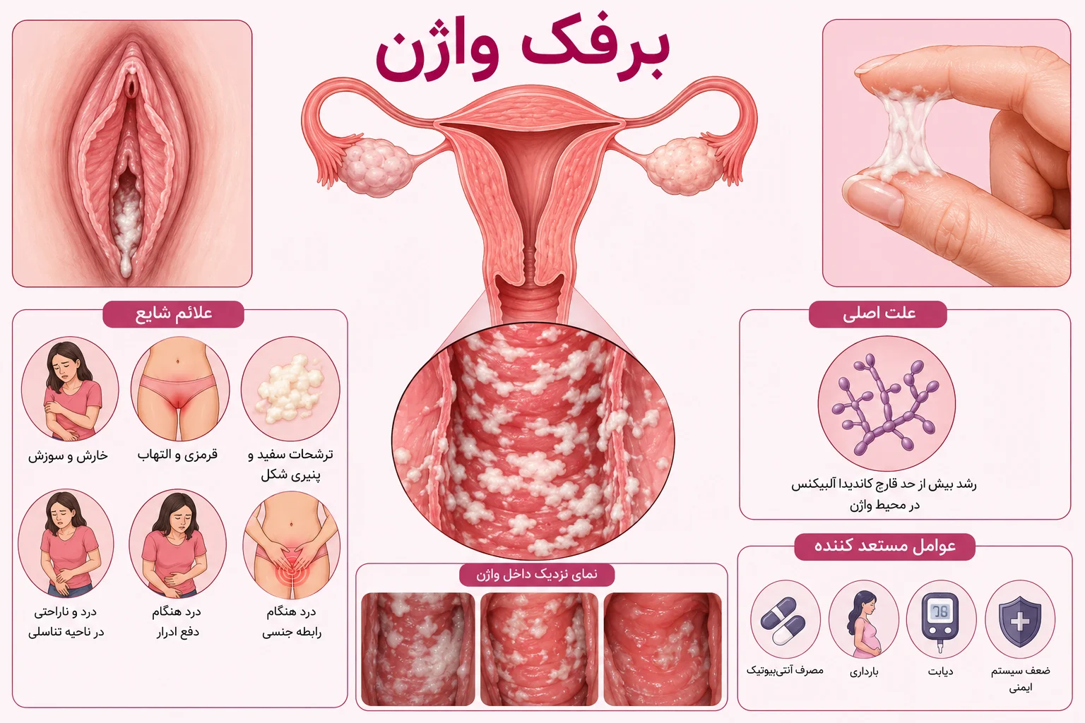 عکس بیماری برفک واژن