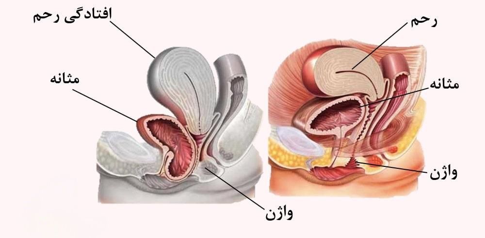 عکس واقعی افتادگی مثانه